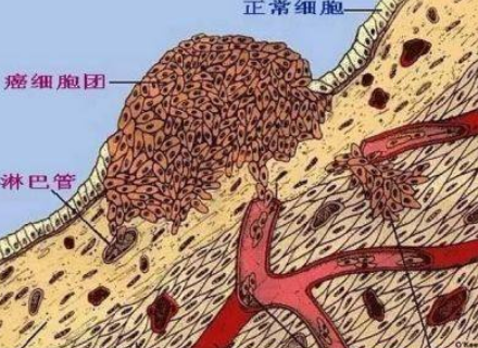 揭秘古人为什么就不得癌症 不只是运气好那么简单