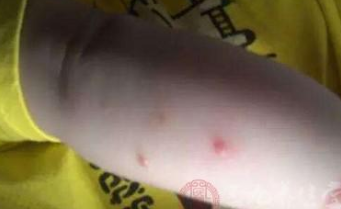 “长秃疮害脚气”语底是什么？关于生疮的歇后语介绍